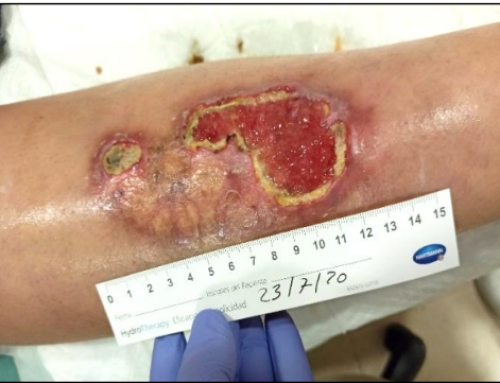 Abordaje con corticoides tópicos y compresión terapéutica de un caso clínico de necrobiosis lipoídica ulcerada