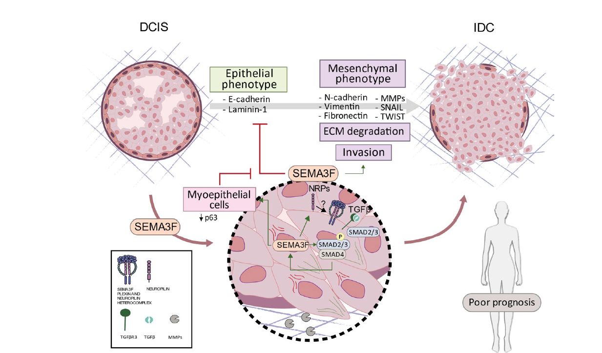 the-sema3f-nrp1-nrp2-axis-is-a-key-factor-in-the-acquisition-of-invasive-traits-in-in-situ-breast-ductal-carcinoma