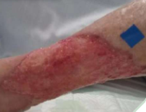 Combination of advanced therapies to cure a Martorell Ulcer